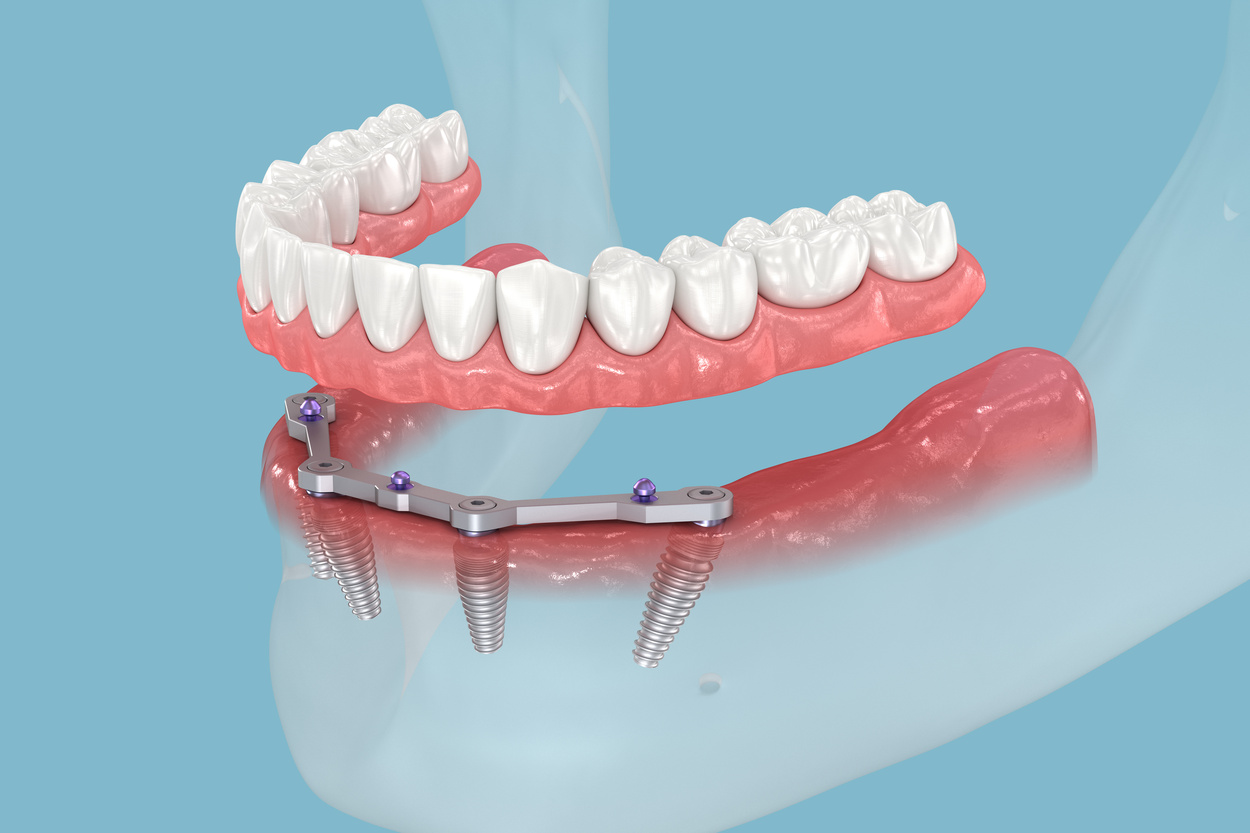 Mandibular prosthesis with gum All on 4 system supported by implants. Medically accurate 3D illustration