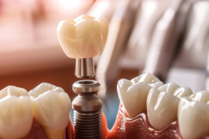 Dental Implants