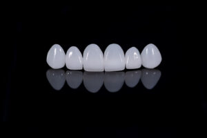 dental veneers