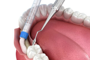 Bone grafting